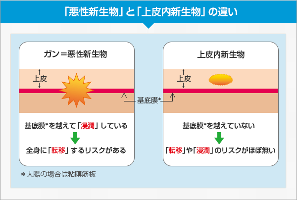 悪性新生物と上皮内新生物